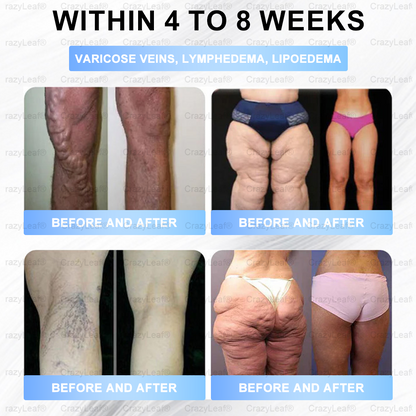[Last Day Promotion 60% OFF] 💎Buildleaf® Tirzepatide Slimming & Health Nano Microneedle Patch 🇺🇸👩‍⚕️(Zero Pain, 24/7 Release | Lose 20lbs FAST | 90%Sugar DropI) (Copy)